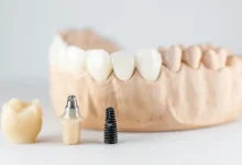 what-makes-tooth-implants-look-and-feel-natural?