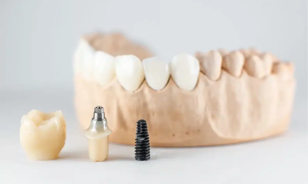 what-makes-tooth-implants-look-and-feel-natural?